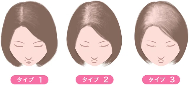 ルードヴィッヒ分類（FAGA）