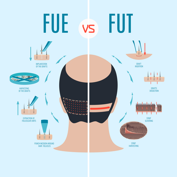 FUEとFUTの模式図