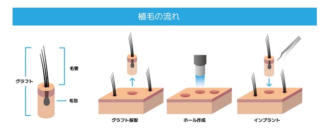 植毛の流れ