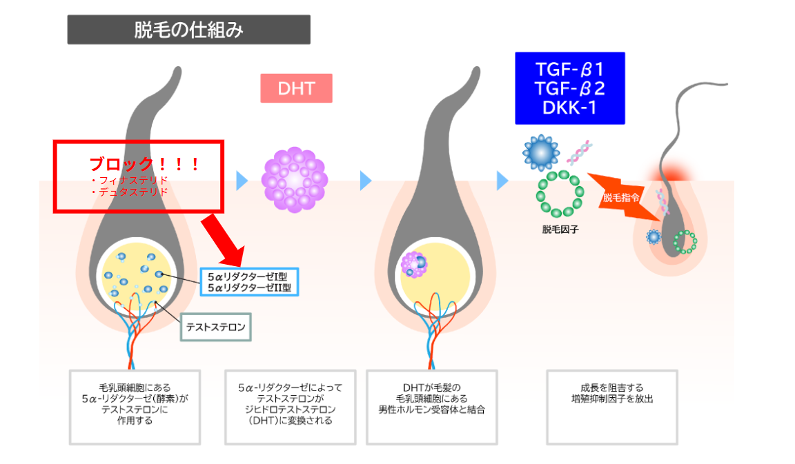 フィナステリドはⅡ型のみブロック・デュタステリドはⅠ型・Ⅱ型をブロック
