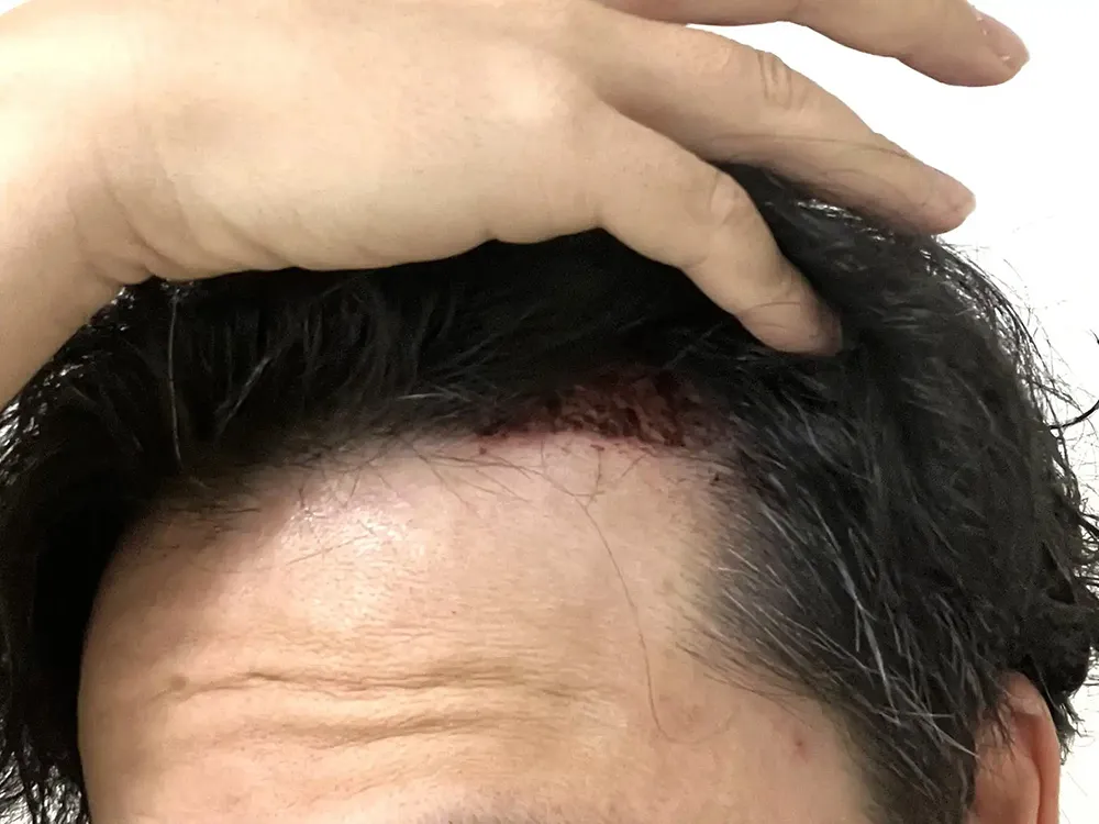 術後2日目の様子
