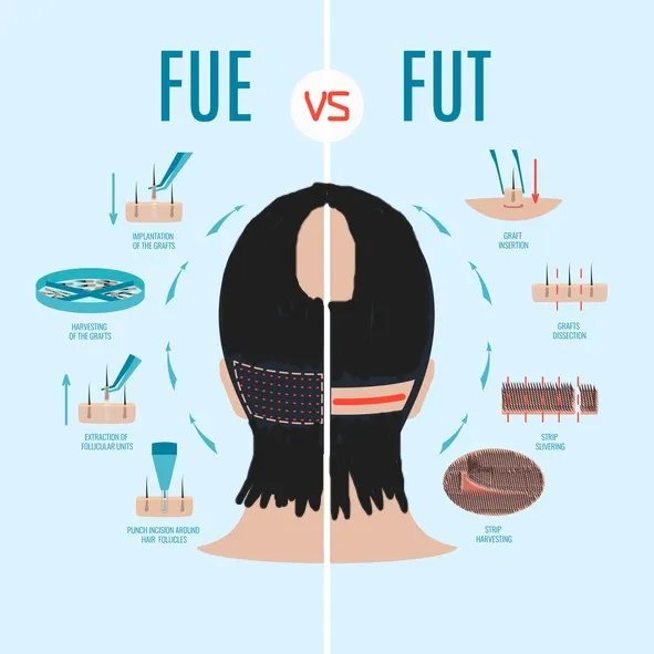 FUEとFUT