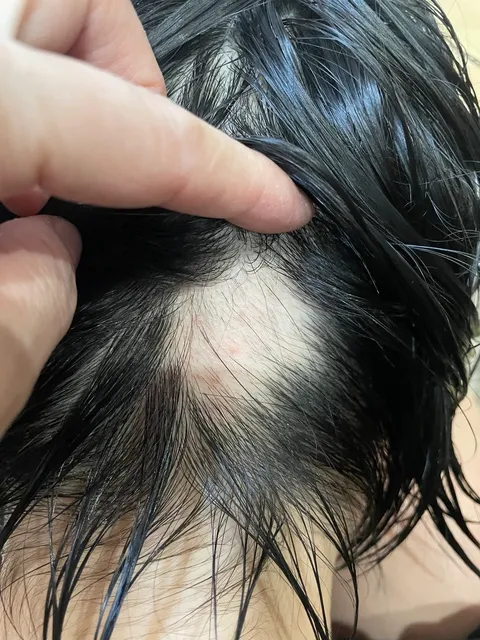 円形脱毛症