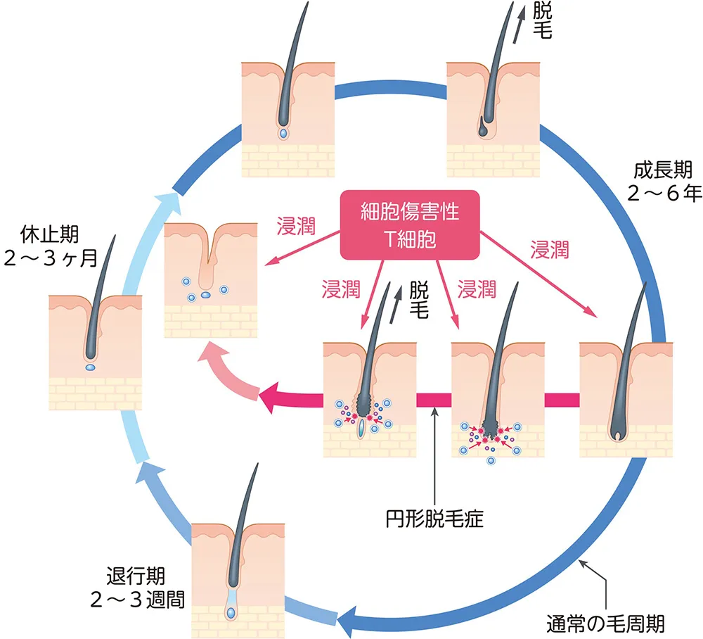 円形脱毛症と毛周期
