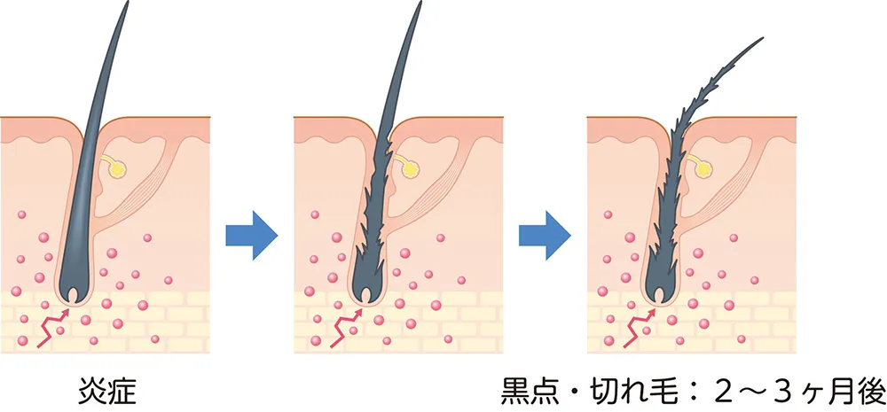 円形脱毛症の仕組み