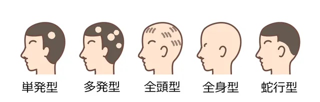 円形脱毛症のタイプ