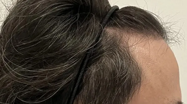 無処置側