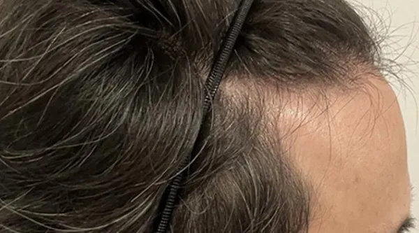 無処置側