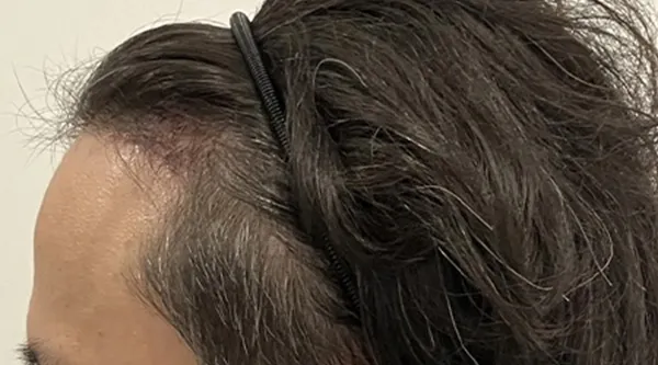 手術側