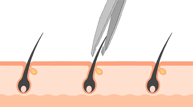 薄毛部分に移植する