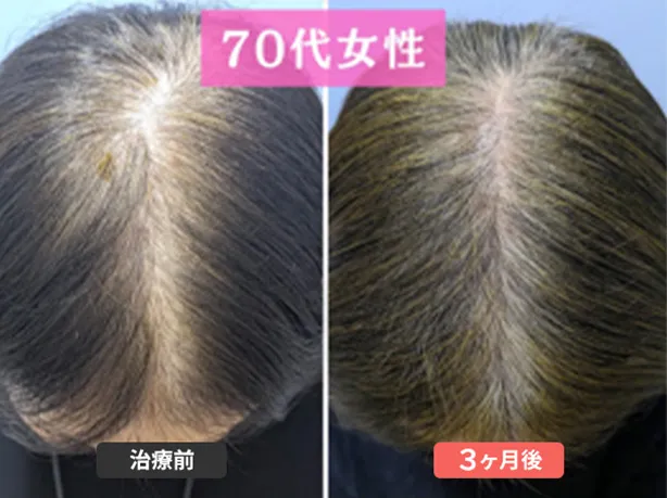 症例４　78歳　女性