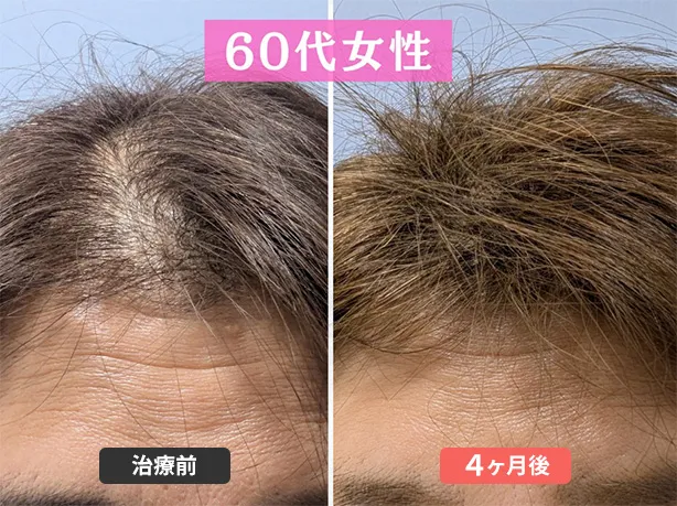 症例６　62歳　女性