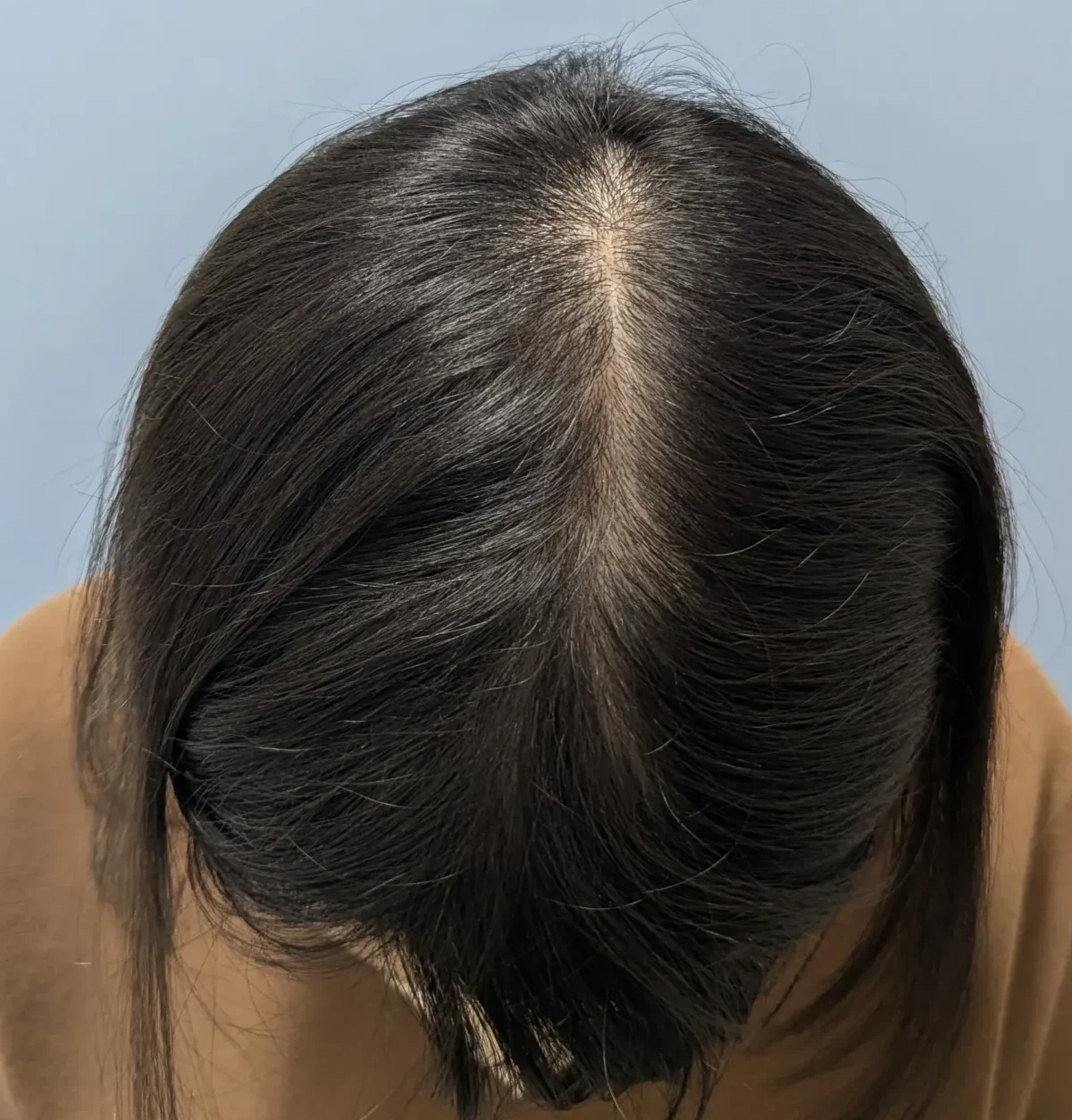 症例02 36歳女性 治療後