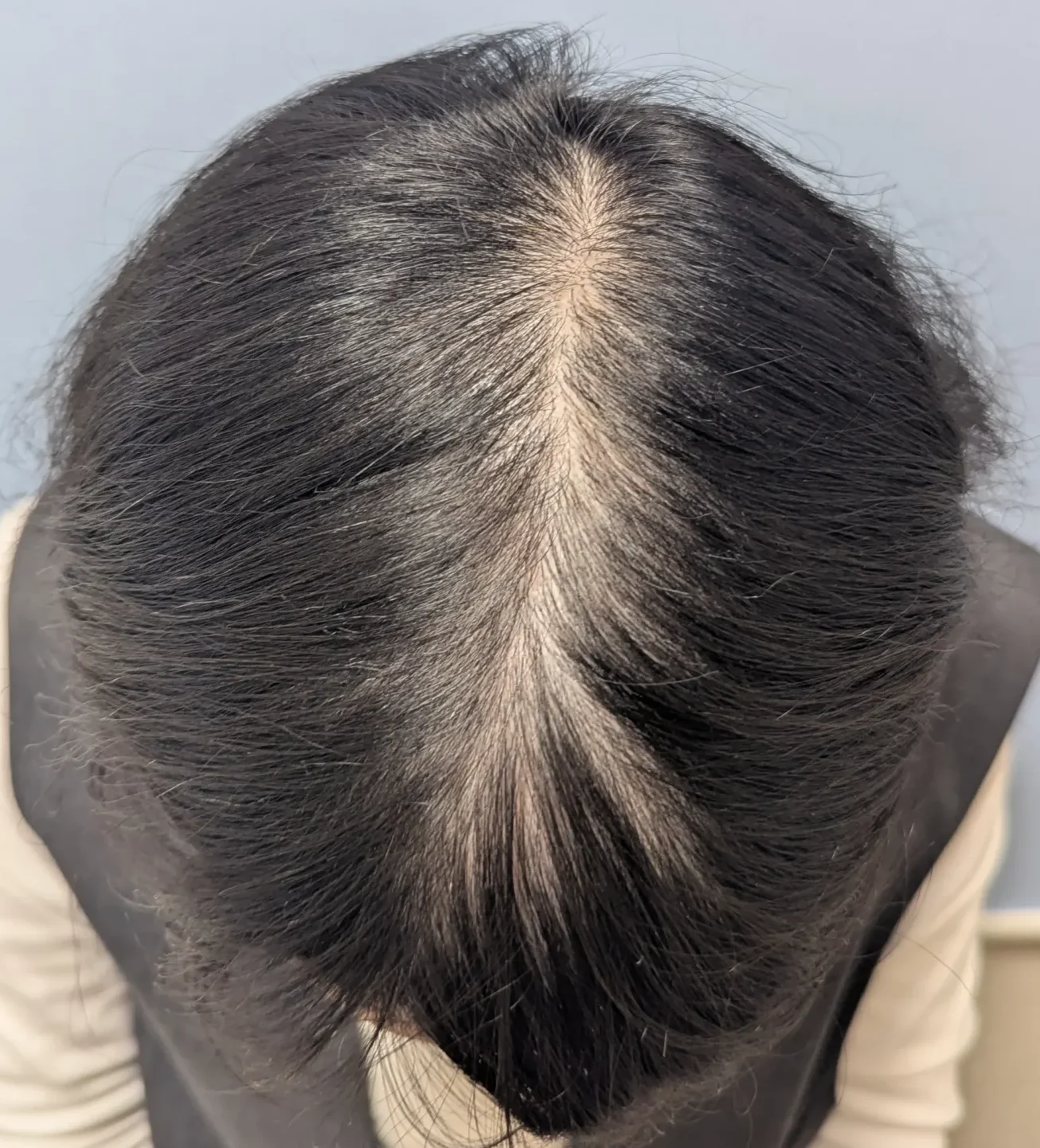 症例02 36歳女性 治療前
